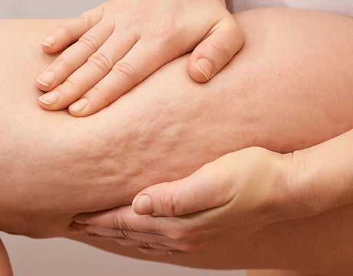 That dimpled, cottage cheese texture on your thighs won't go away no matter what you try.